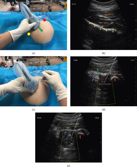 Pdf Ultrasound Guided Pudendal Nerve Block Combined With Propofol