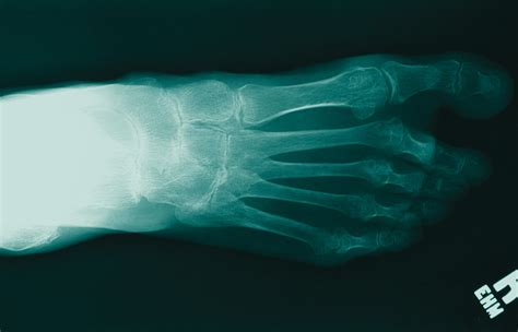 How To Treat An Arthritic Ankle In A Young Patient
