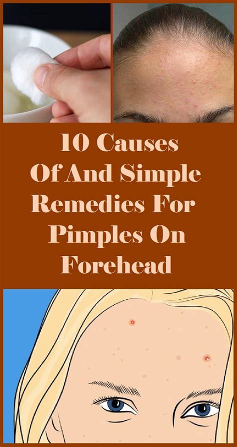 10 Causes Of And Simple Remedies For Pimples On Forehead Pimples On