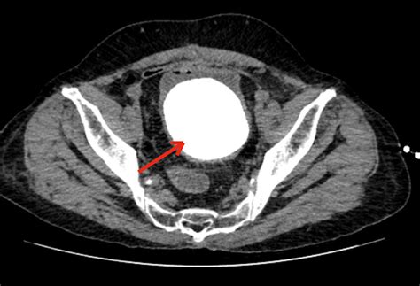 Nonenhanced Pelvic CT Scan Notes The Red Arrow Shows A Large Stone