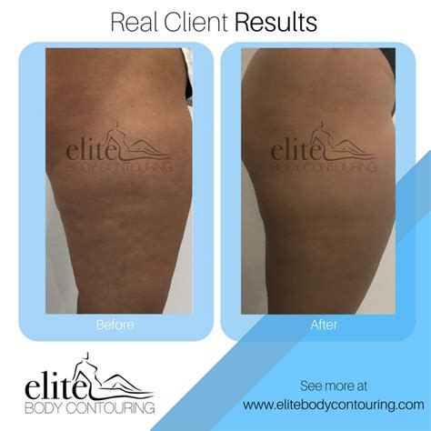 cellulite treatment elite body contouring