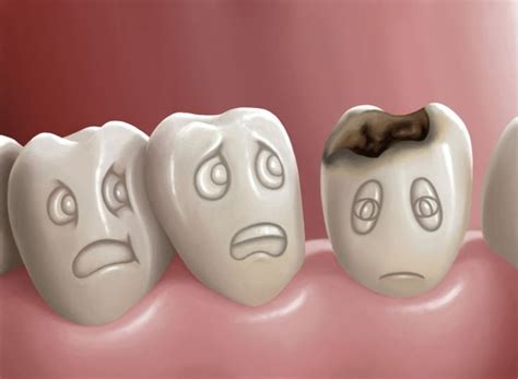 Dental Caries Symptoms Causes Risk Factors
