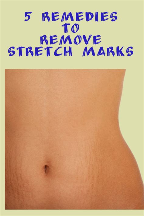 5 Remedies To Remove Stretch Marks