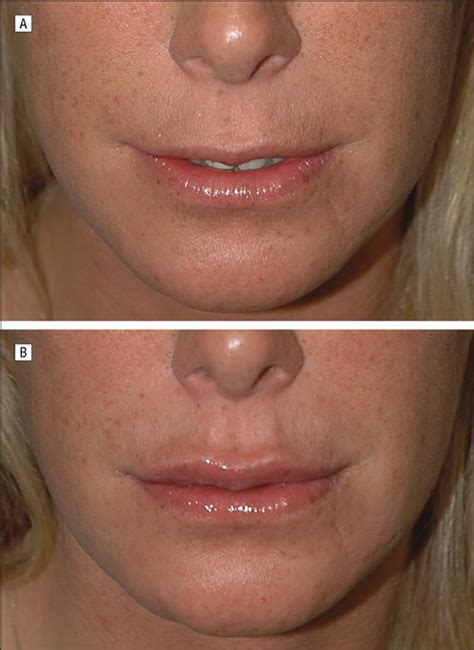 A New Classification Of Lip Zones To Customize Injectable Lip