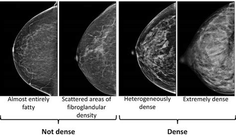 What Does Breast Cancer Look Like On Mammogram Images Breast Density