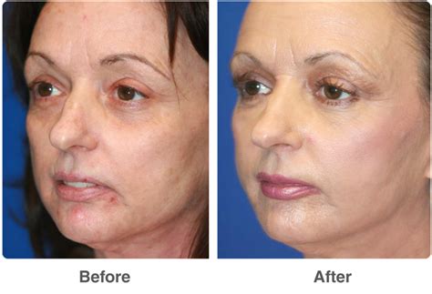 Laser Skin Resurfacing Las Vegas And Laser Skin Rejuvenation Treatment