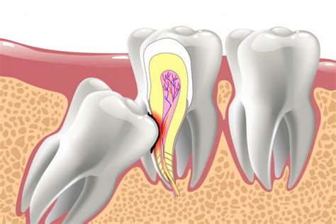 Benefits Of Wisdom Teeth Removal Peel Dental Studio Dentist Mandurah