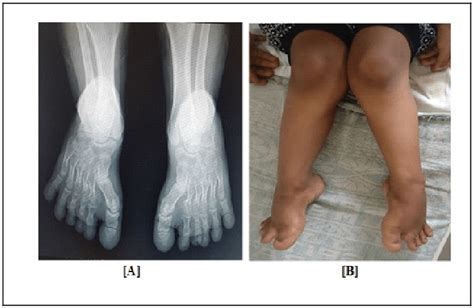 A Knock Kneegenu Valgum B X Ray Foot Showing Short Metatarsals With