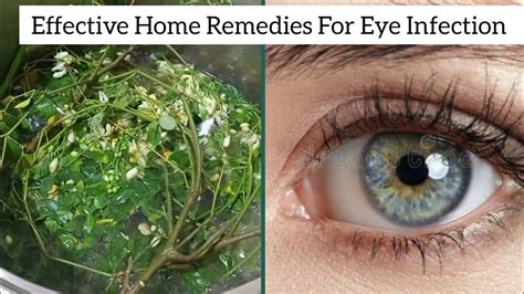 Effective Home Remedies For Eye Infection Treatment Cure For 7days