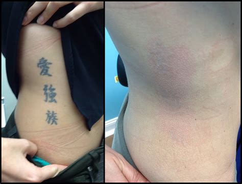 Before And After Tattoo Removal