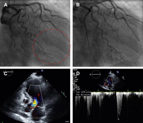 Stress Induced Cardiomyopathy Complicated By Dynamic Left Ventricular