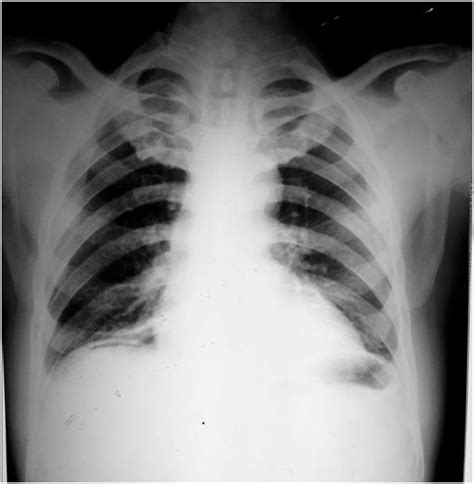 Chest X Ray Pa View Showing Gas Under Right Diaphragm Download