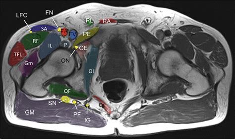 Proximal Sciatic Nerve Entrapment Springerlink