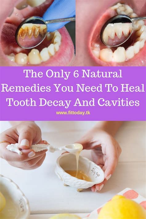 The Only 6 Natural Remedies You Need To Heal Tooth Decay And Cavities