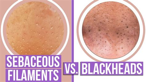 Sebaceous Filaments Vs Blackheads What Are The Differences Youtube