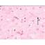 HPE From Neck Tissue Of CASE I Showing Many Large Histiocytes With 