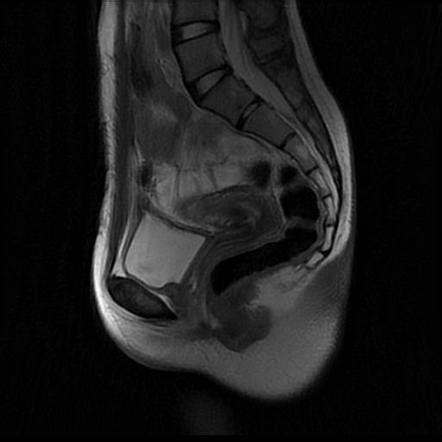 Uterus Didelphys Radiology Case Radiopaedia Org
