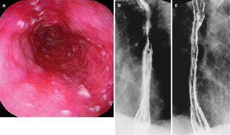 Hiv Aids Related Gastrointestinal Diseases Radiology Key Free Hot