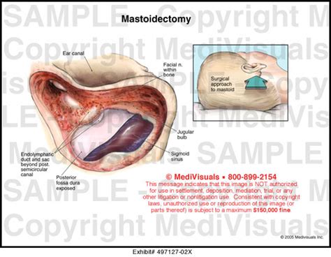 Mastoidectomy Anatomy