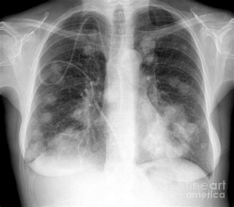 Hq Images Cat X Ray Lung Cancer Lung Cancer In Cats Treatment