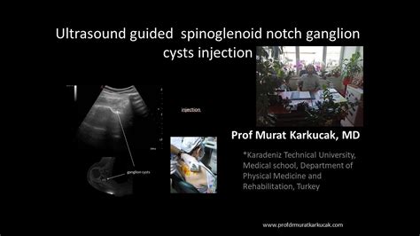 Ultrasound Guided Spinoglenoid Notch Ganglion Cysts Injection Youtube