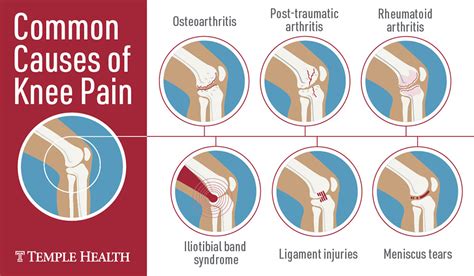 Total Knee Replacement Pain Management Protocol Lansdentrautman