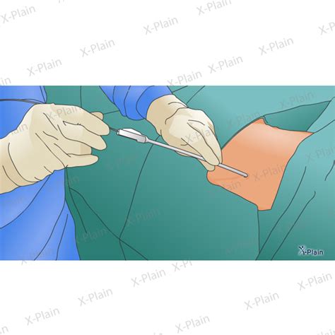 Nephrostomy Inserting Tube