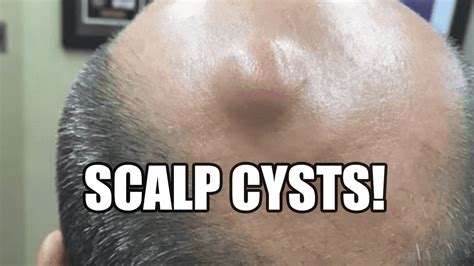 Pilar Cysts What S Inside Symptoms And Treatment Youtube