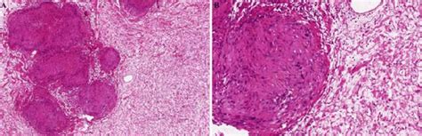 Hybrid Neurofibroma Schwannoma A B These Tumors Exhibit The