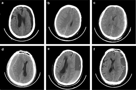 Head Ct Scans Showing Classification Of Chronic Subdural Hematoma A Download Scientific