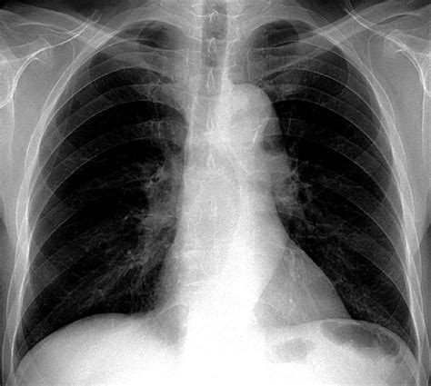 A Normal Preoperative Chest X Ray Posteroanterior View Download