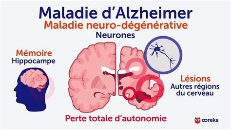 Alzheimer Symptômes Facteurs De Risque Traitements Vidéo Dailymotion