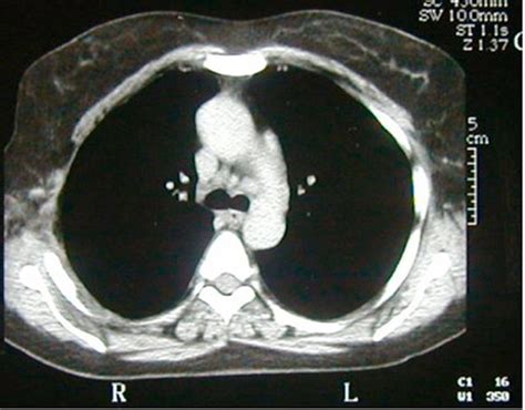 Aneurysmal Bone Cyst Of The Rib A Case Report Springerlink