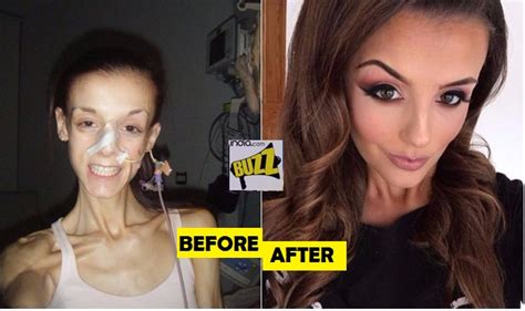 See Before And After Pictures Of Girl Beating Anorexia Boyfriends ‘fat