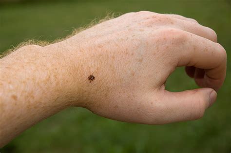 Stings And Insect Bites Home Treatment