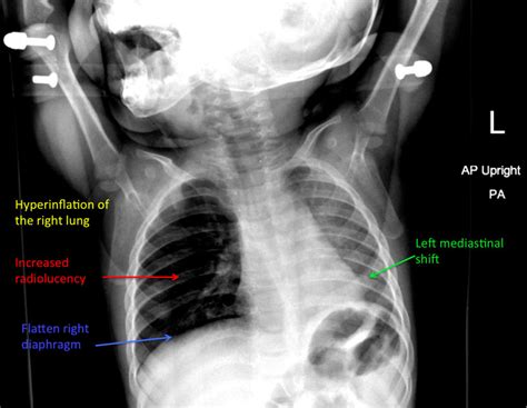 Pediatric Foreign Body Chest X Ray Annotated Jetem 2018 Jetem
