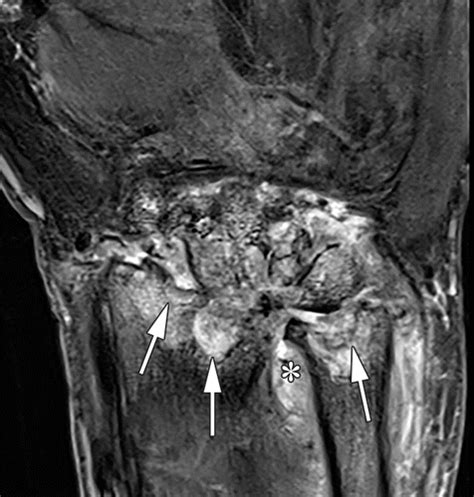 Mr Imaging And Us Of The Wrist Tendons Radiographics