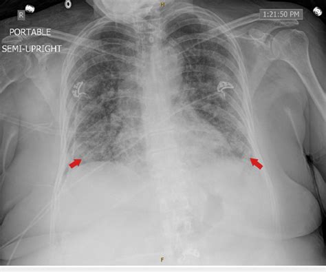 Cxr On Admission Showed Diffuse Bilateral Infiltrates Cxr Chest X Ray
