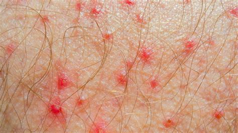 Know Everything About Atopic Dermatitis Smart Health Bay The Key To