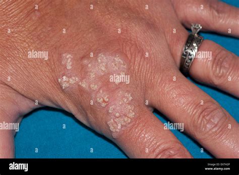 Hand Lesions Showing Inflammatory Linear Verrucous Epidermal Nevus