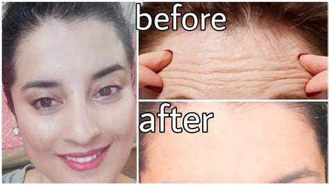 Face Massage For Forehead Wrinklestips Skincare Face Exercises