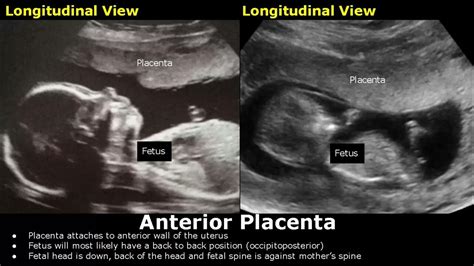 Placenta Positions On Ultrasound Anteriorposteriorfundallateral