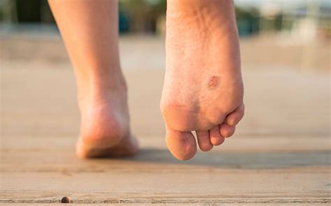 Skin Conditions Of The Feet