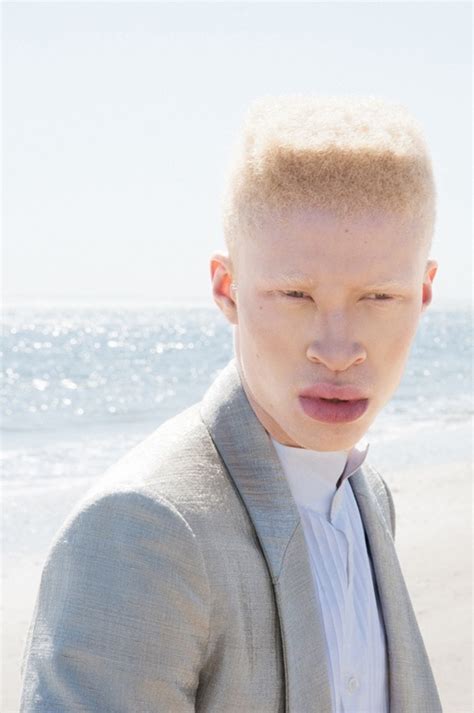 Amoeslolo Albinism Albino Model Albino Human