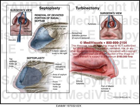 Medivisuals Septoplasty And Turbinectomy Medical Illustration