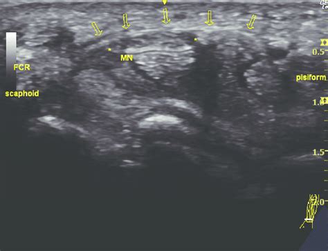 Transverse View Of A Right Wrist Ultrasound In A 41 Year Old Male