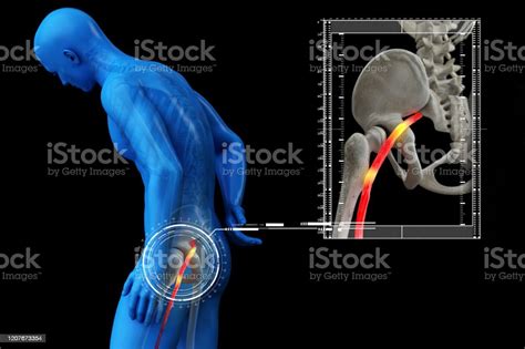 Pinched Human Sciatic Nerve Anatomical Vision 3d Render Stock Photo
