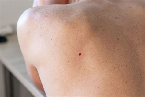 Cherry Angiomas Edmonton Dermatology