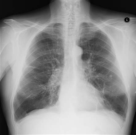 It is part of a larger family of structurally. Alpha-1-antitrypsin deficiency | Image | Radiopaedia.org