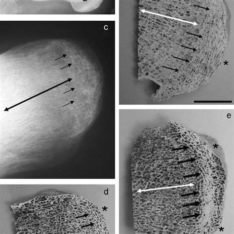 The Basic Arrangement Of The Subcortical Systems Of Cancellous Bone Of